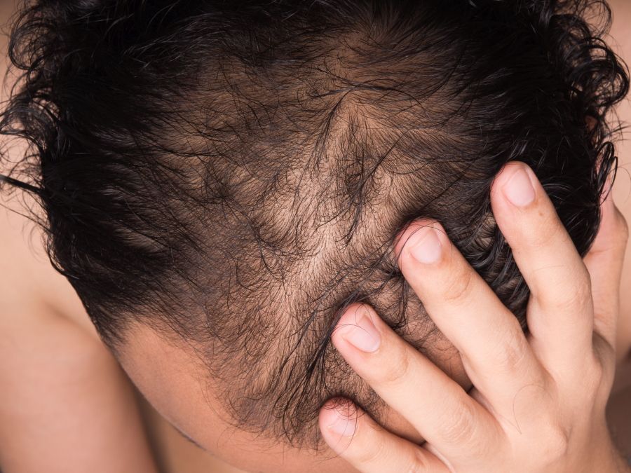 Dense hair